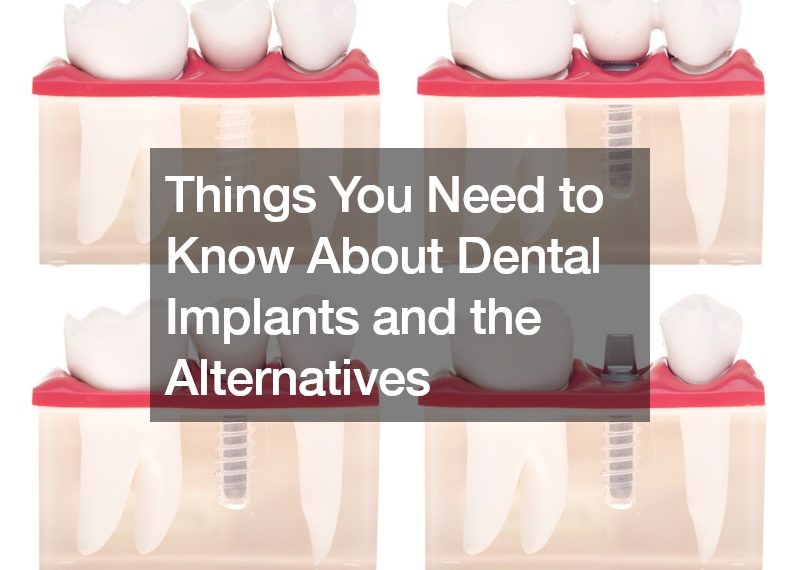 Things You Need to Know About Dental Implants and the Alternatives